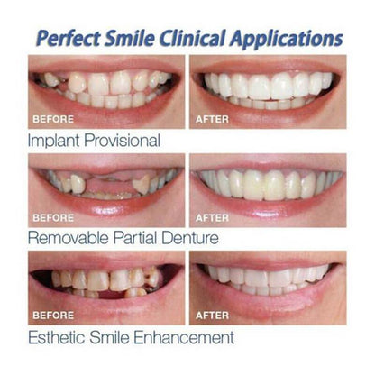 INSTANT SMILE VENEER -Upper & Lower Include