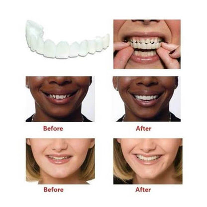 INSTANT SMILE VENEER -Upper & Lower Include